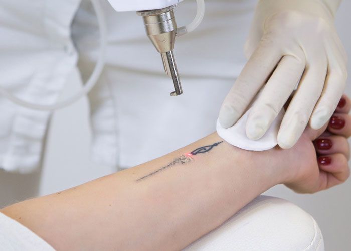 Tattoo Removal