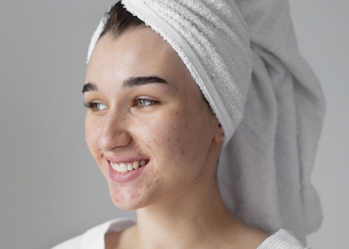 Acne and acne scar care