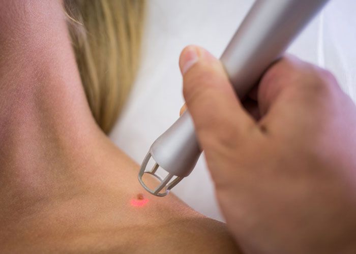 Ink Be Gone: Easy Tattoo Removal at Almeka Kochi! | Almeka Medical Centre  laser tattoo removal